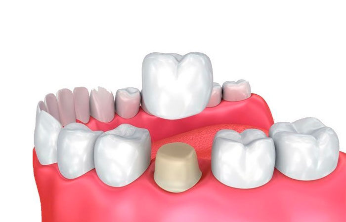 corona dental en madrid centro
