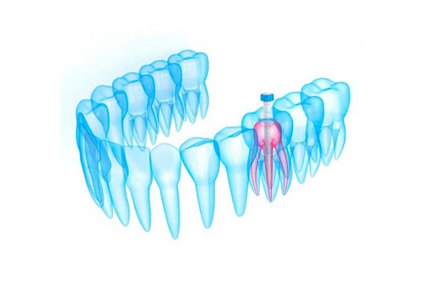 dentista ENDODONCIA en madrid centro