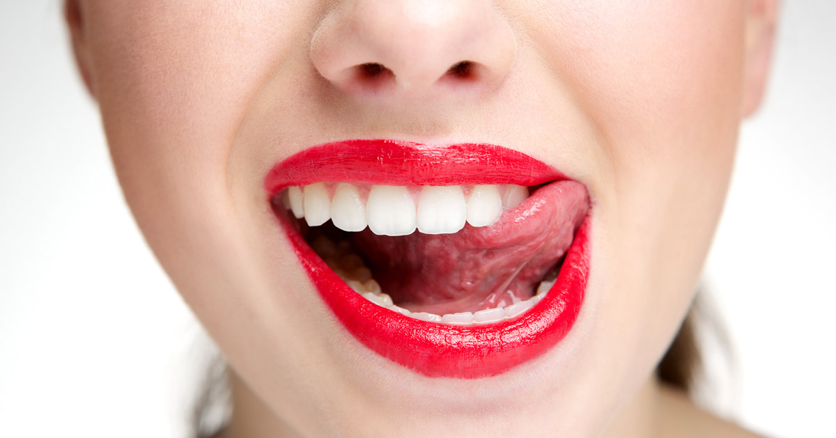 carillas dentales