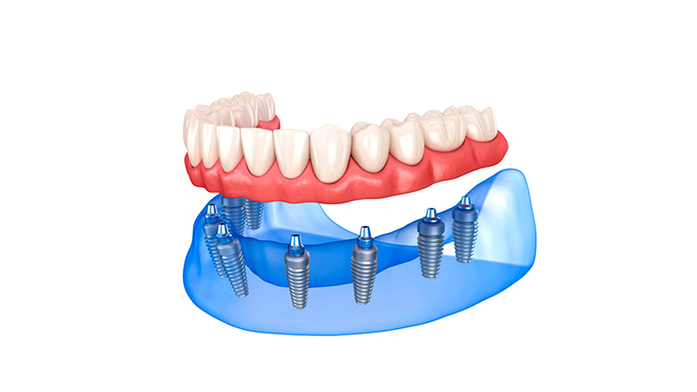Prótesis dental en Madrid centro