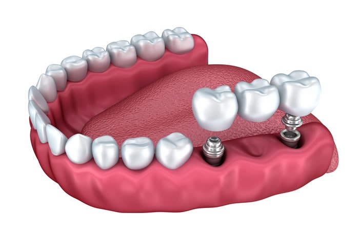 puente dental en madrid centro