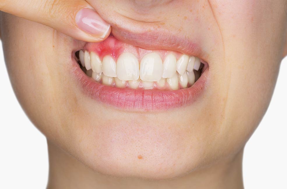 periodontitis