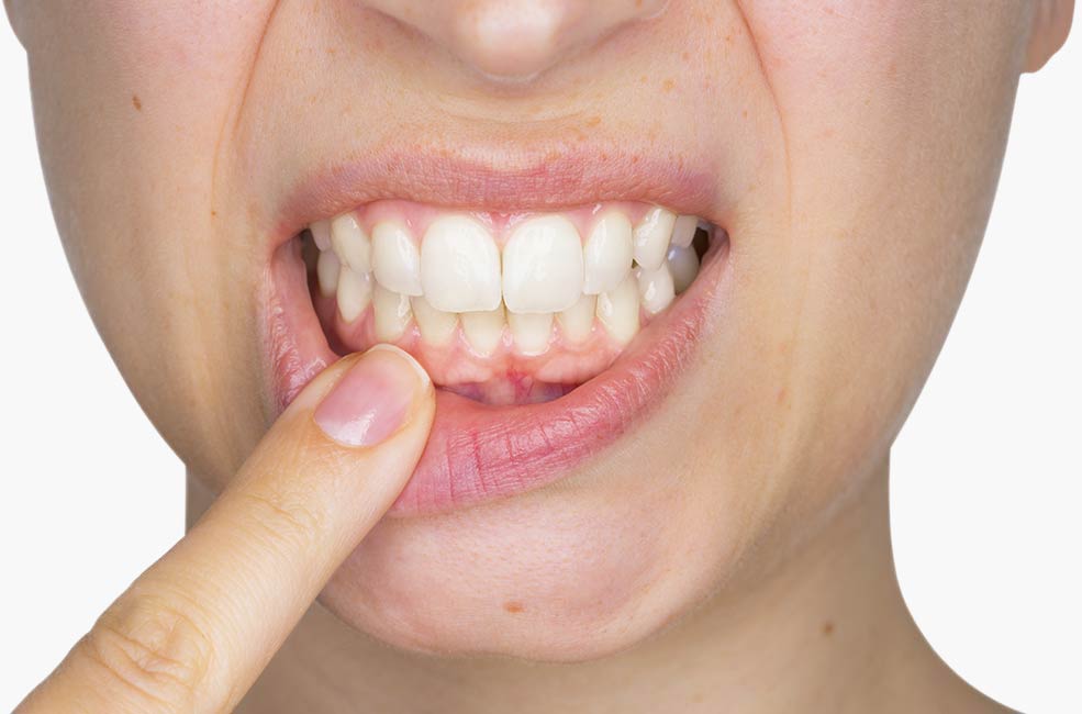 gingivitis