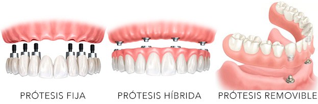 tipos de prótesis detnales