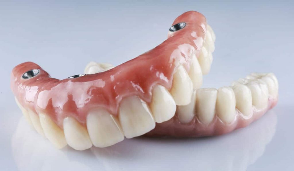 Prótesis dental híbrida