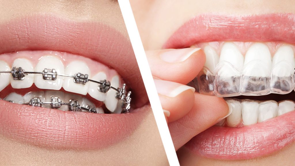 Diferencias entre ortodoncia tradicional e invisible