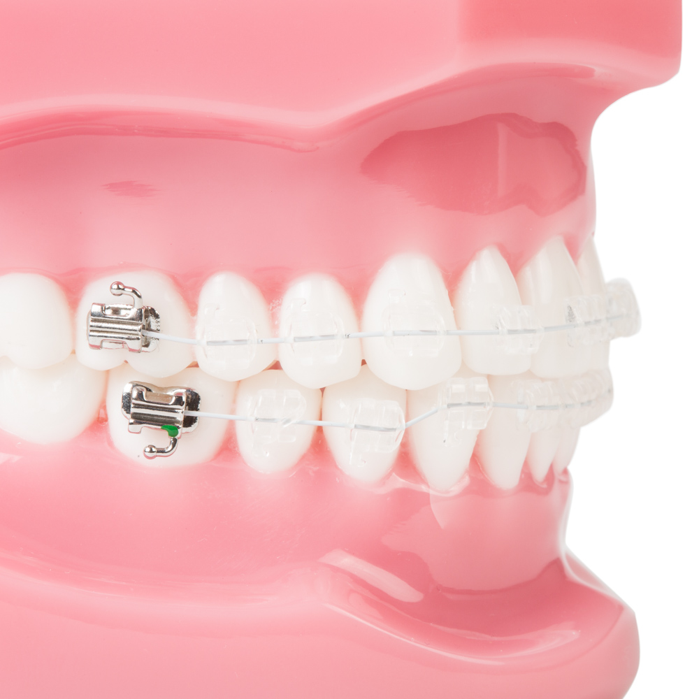 Ortodoncia Estética Brackets de Zafiro en Madrid Conde Duque