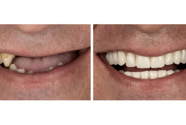 Caso Implantes Dentales en Madrid Centro
