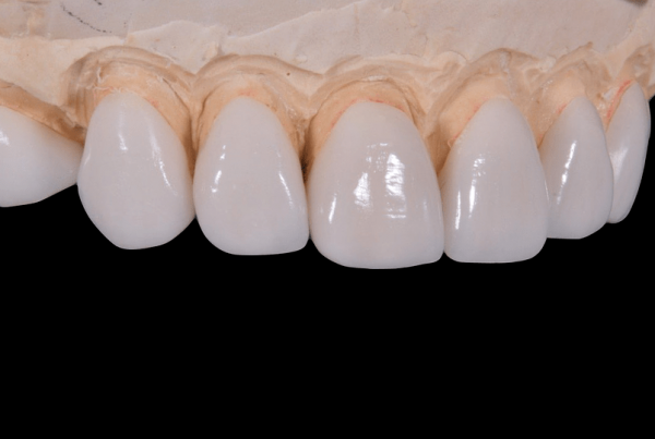 el zirconio en prótesis dentales