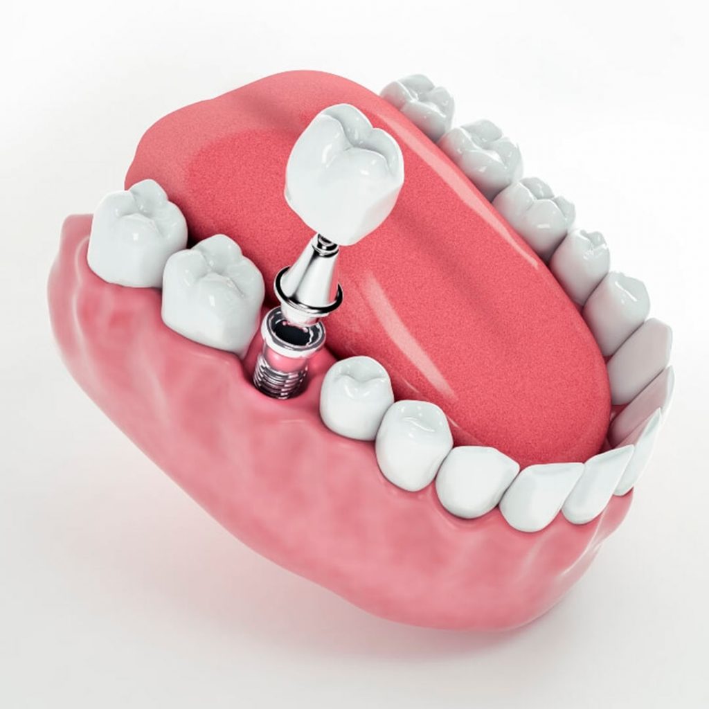 Implante Dental Precio Madrid