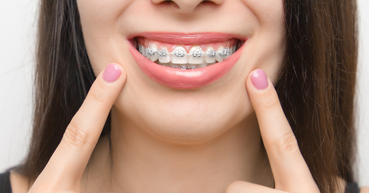 ¿Qué son los Brackets Autoligables? Conde Duque